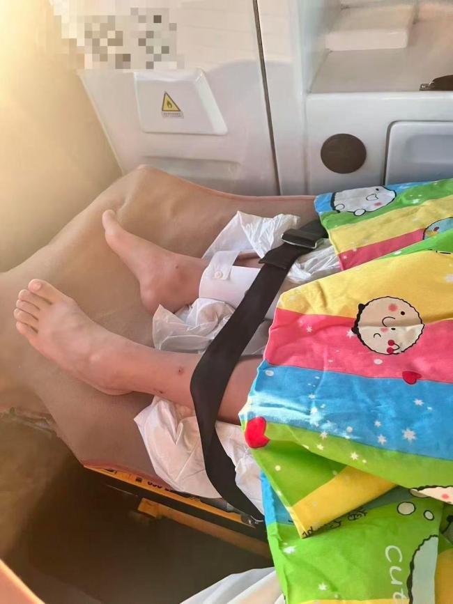 列车上铺男子跌落砸断10岁女孩腿骨 后续治疗漫长