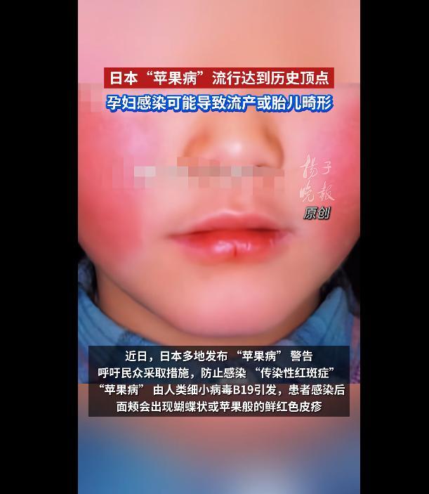 日本“苹果病”流行达历史顶点 感染率创纪录